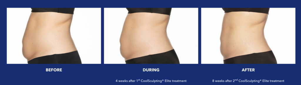Coolsculpt before and after